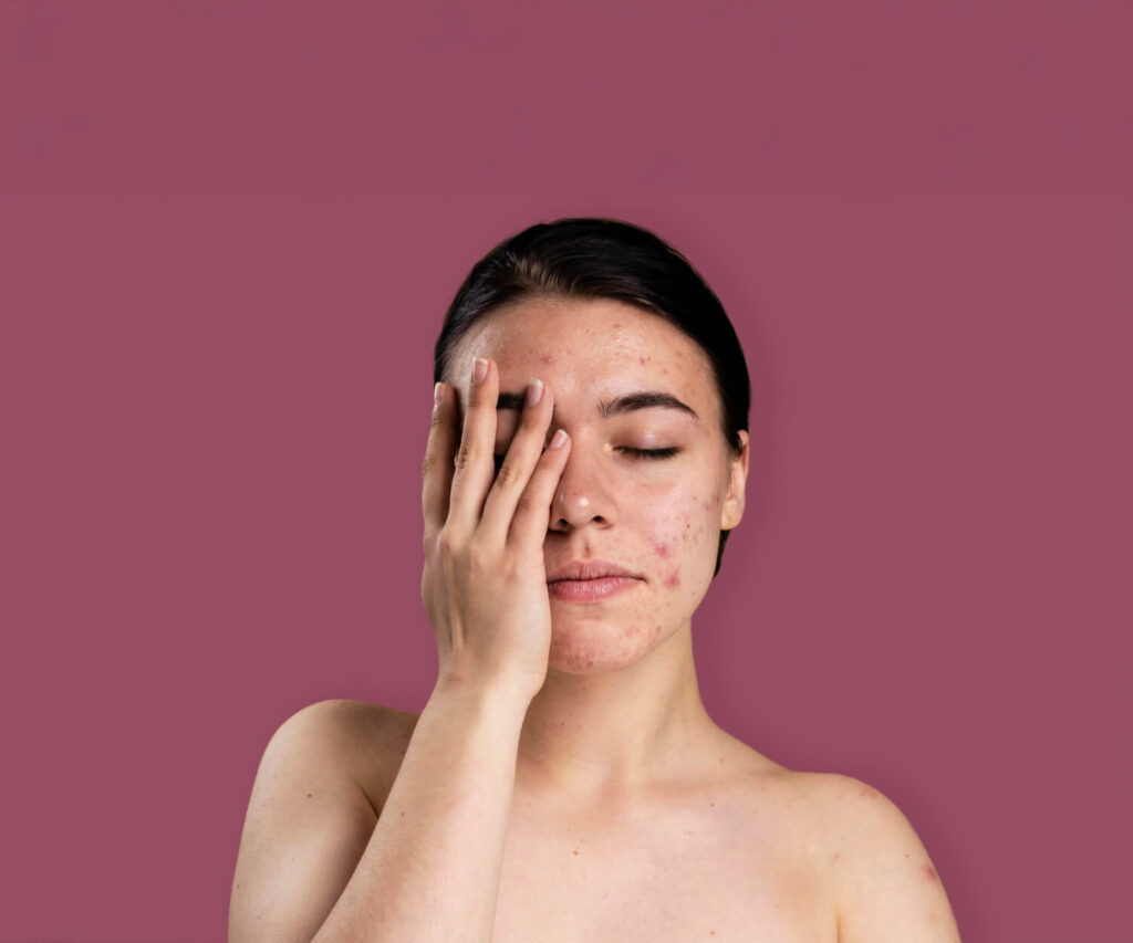 Adult woman touching her face with visible hormonal acne on the cheek