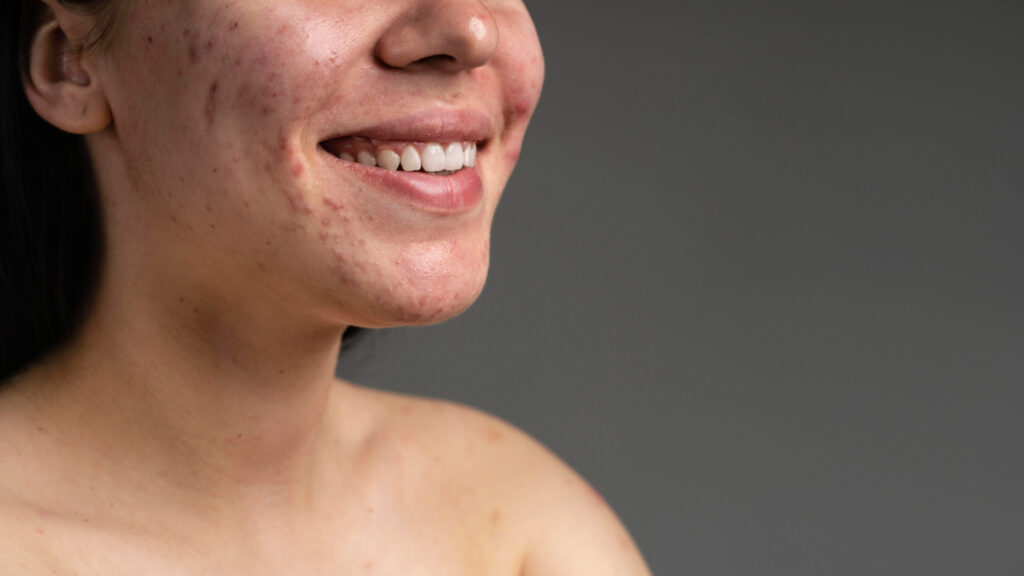 Close up of woman smiling with visible acne on jawline and chin. What PCOS acne looks like