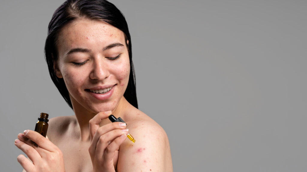 Woman with acne-prone skin applying Niacinamide, skincare routine for PCOS