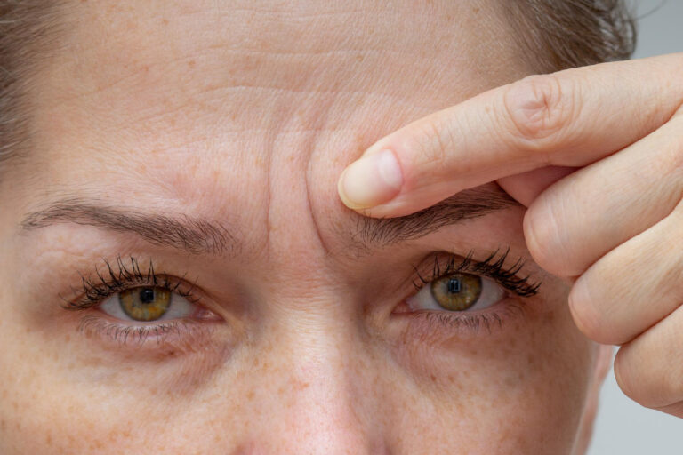 Close up of forehead fine lines showing acne and wrinkles at the same time in your 30s