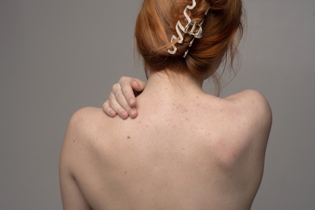 Woman with back acne and body breakouts on her shoulders and upper back
