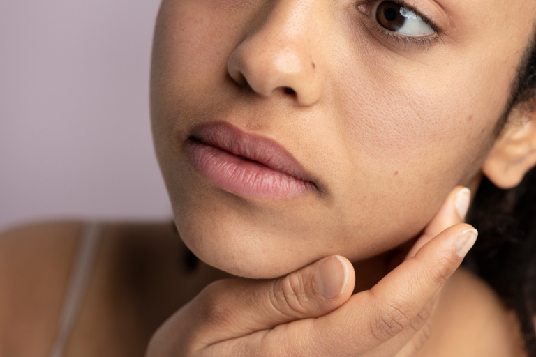 Close-up of a woman with medium-deep skin tone showing dark spots around the mouth and chin area