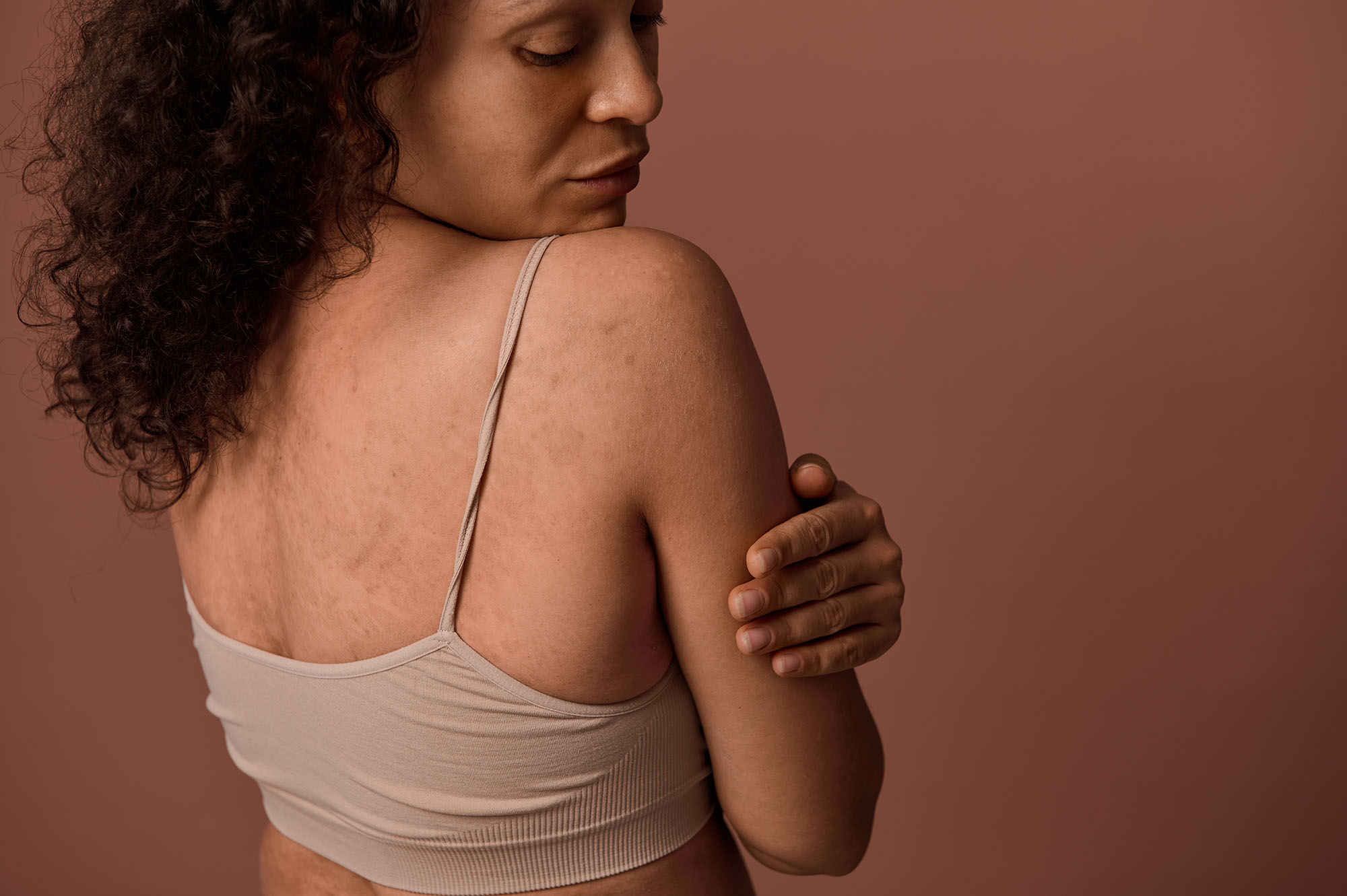 Woman touching her shoulder, showing breakouts and uneven texture across her upper back